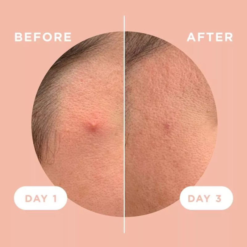 ZitSticka KILLA Patch 4 Count Microdart Zit Treatment for Hard