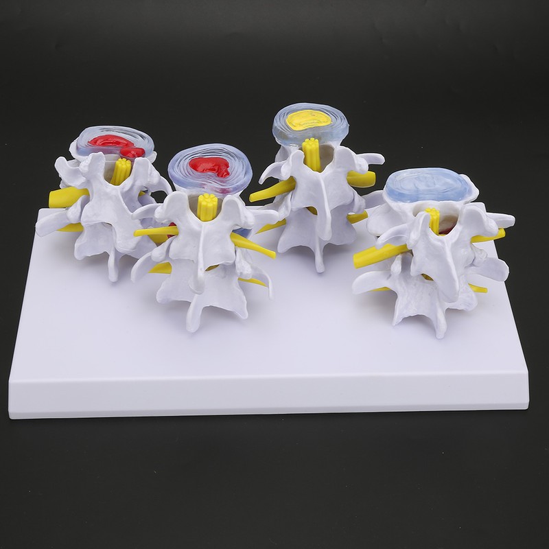 4-stage Medicals Human Lumbar Vertebrae Combination of Normal and Pathological