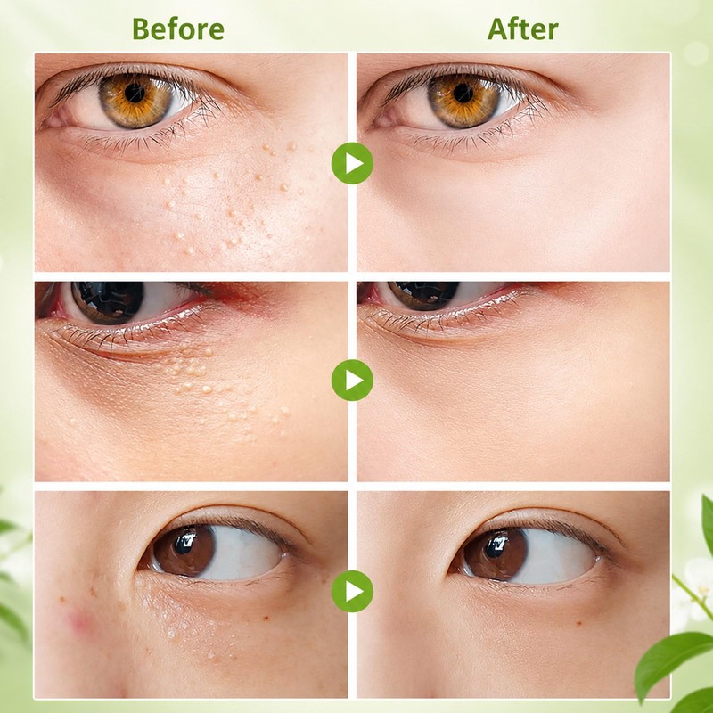 Vitamin E Milia Cream - Milia Daily Eye Care for