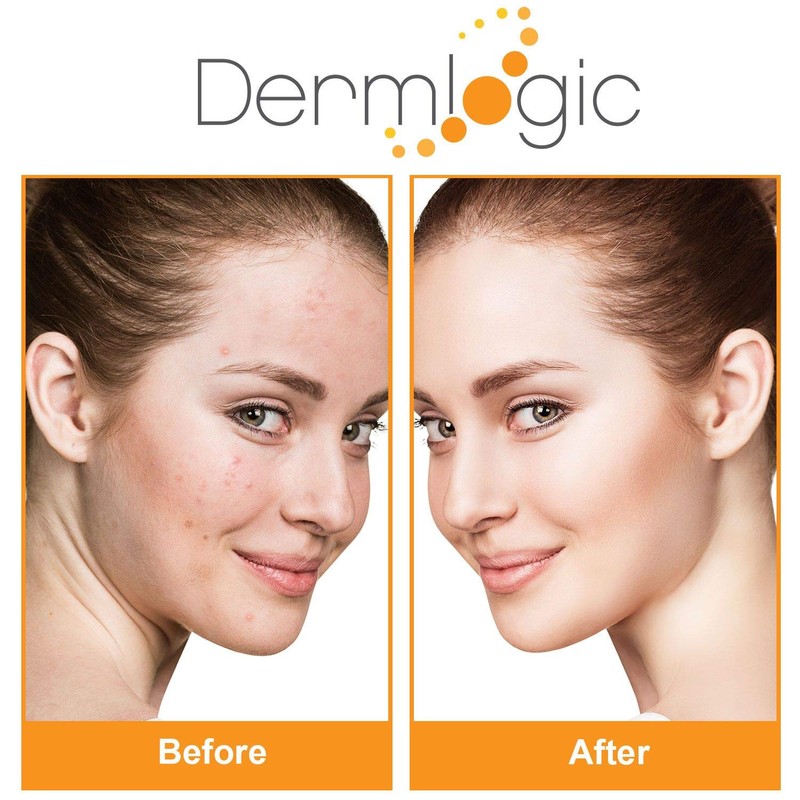 Acne Treatment Control Pads- Contains Salicylic, Glycolic, & Lactic Acid