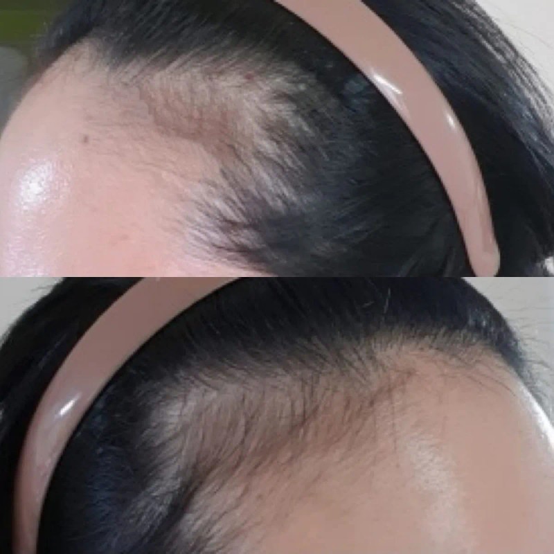 Mikrogan Creme Para Cejas Y Cafeína De Barba Que Contiene