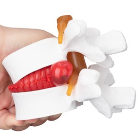 faruijie Anatomical Lumbar Vertebral Model - 1.5X Human Lumbar Disc Herniation Demonstration Model Disc Herniation Model Intervertebral Disc Model