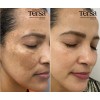 Crema Despigmentante Quita Manchas Acné Paño Vitíligo 30g Todo Tipo