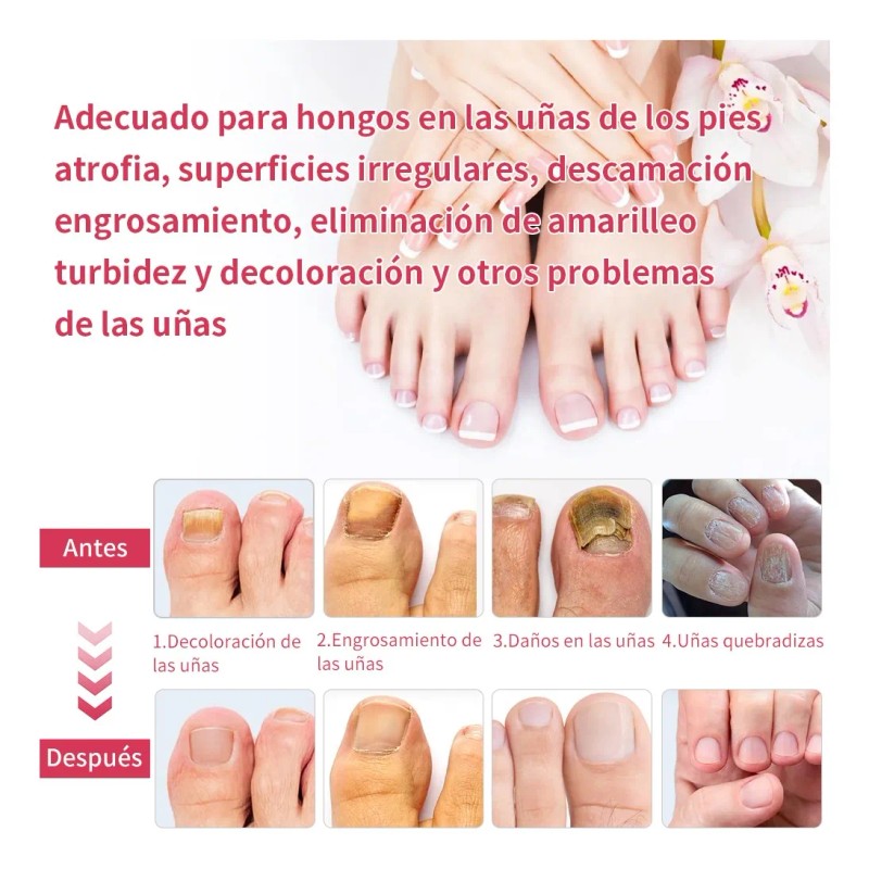 Líquido Para Hongos En Las Uñas Tratamiento Efectivo 50ml