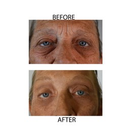 Dr.Sevinor Skincare Solutions Dr Sevinor Combo Genuine Face Lift Solution 4oz. and Wrinkle Smoothing Solution Tinted Serum 1 Fl. Oz. 2-Pack Special Save 10% Feel the Confidence! Sold by Dr.Sevinor