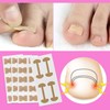 Suweiyuanshiyi Ingrown Toenail Removal Kit,Ingrown Toenail Corrector Tools Come with
