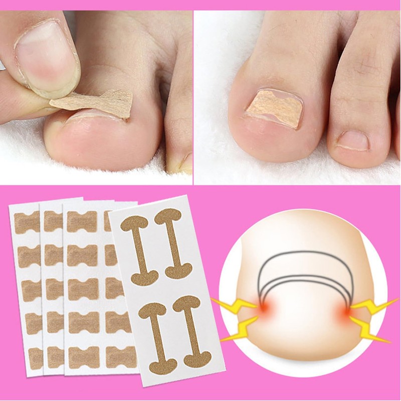 Suweiyuanshiyi Ingrown Toenail Removal Kit,Ingrown Toenail Corrector Tools Come with