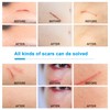 Adhesive Silicone Scar Patch Safety Mild Fade Scar Scar Reduction