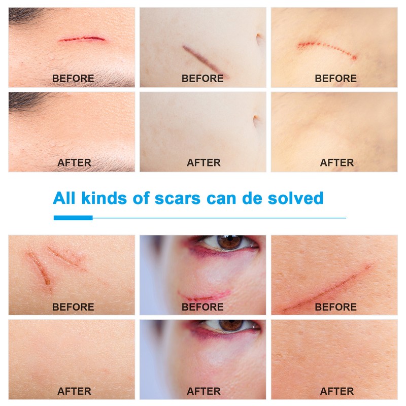 Adhesive Silicone Scar Patch Safety Mild Fade Scar Scar Reduction