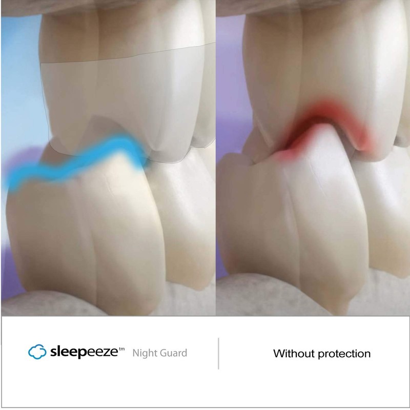 Sleepeeze Night Guard - Custom Fit Mouth Guard Designed For