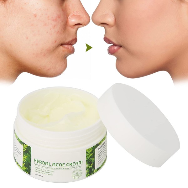 Whitening Cream 50G Acne Removal Cream Plant Extraction Anti Acne Removal Moisturizer
