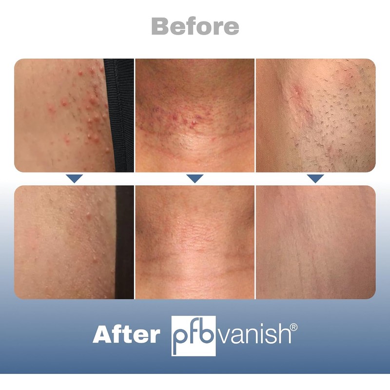Pfb Vanish Hair Treatment