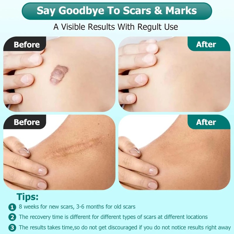 Scar Gel, Scar Cream, Advance Scar Gel for Surgical Scars,Face,Bod<wbr/>y,Leg,