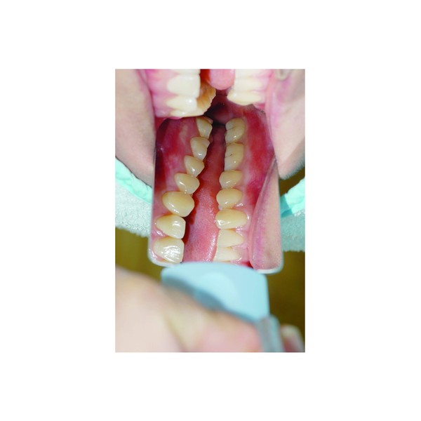 OSUNG - Intraoral Photography Dental Mirror with Handle (Occlusal Medium)