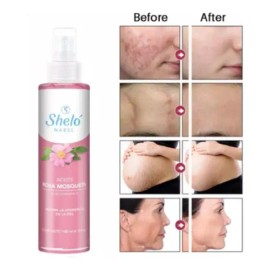 Aceite Rosa Mosqueta Mejora La Textura De Tu Piel Shelo Nabe                                                                                          