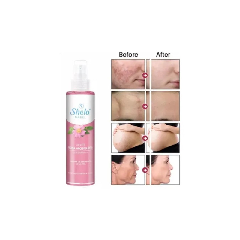 Aceite Rosa Mosqueta Mejora La Textura De Tu Piel Shelo