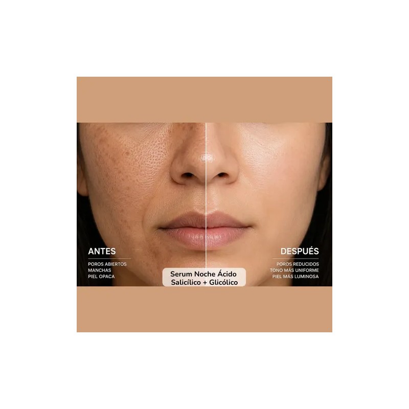 Serum Noche Ácido Salicílico + Glicólico Anti Acné Y Manchas