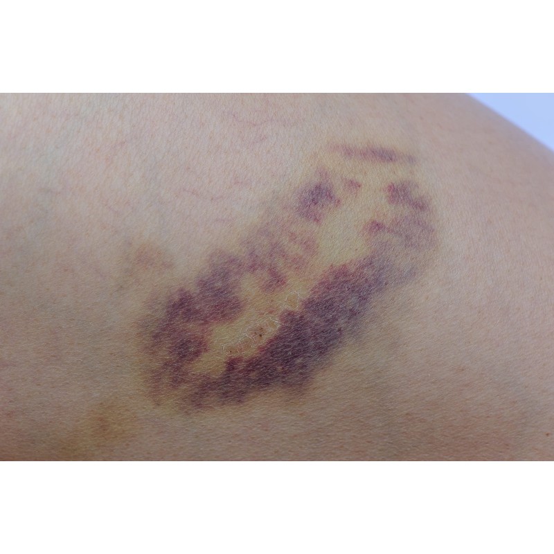 Arnica Bruise Cream Arnica Oil for Bruising Arnica Massage Oil