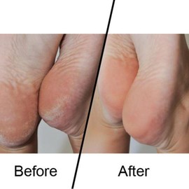 FNX Original Emjoi Micro Pedi Coarse Micro-Mineral Rollers | Cracked, Hard Skin & Callus Remover for Feet & Heels - Removes Dry & Dead Skin Instantly for a Professional Pedicure & Salon Feel | 2 Pack