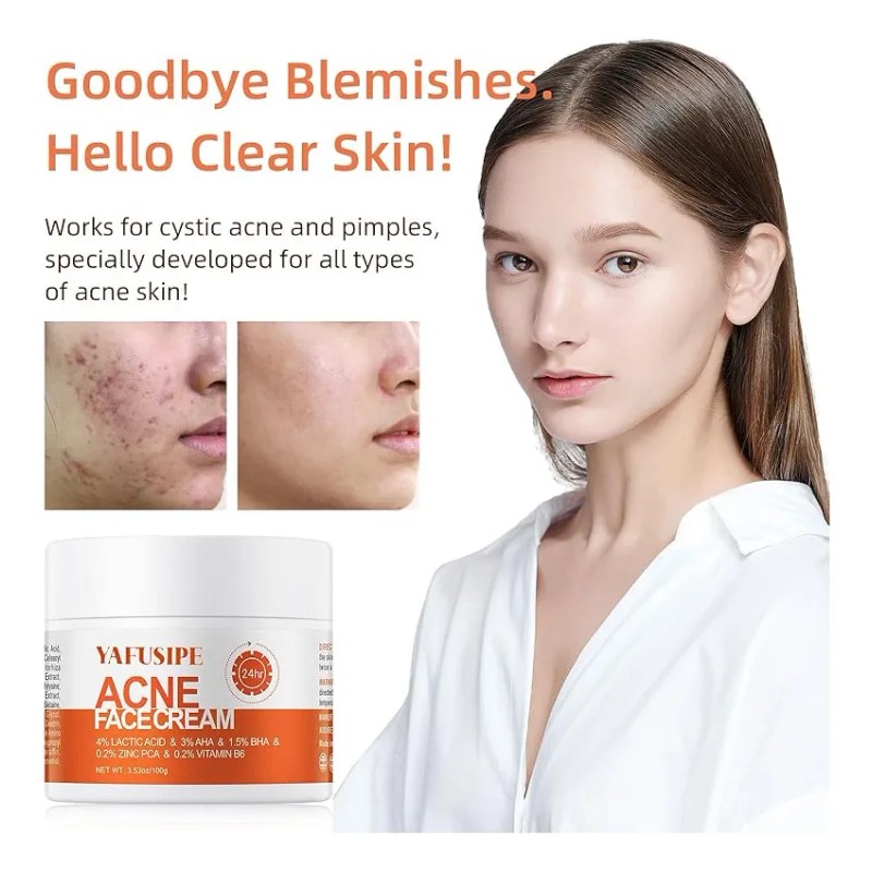 Crema De Tratamiento Del Acné For Espinillas, Puntos Blanc I