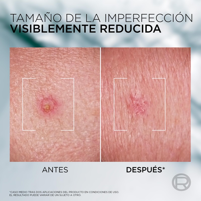 L'Oréal Paris Men Expert Derma Control S.O.S Pimple Paste Anti-Impact