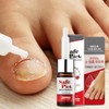 MEDIPICKME Safepick Intensive Nail Strengthener Serum for Weak, Thin &