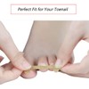 EBANKU Ingrown Toenail Treatment Strips, 20 Pcs Toe Nail Correction
