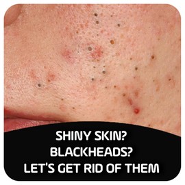 Asepxia Asepxia with Activated Charcoal Purifying Effect Acne Treatment Bar Soap with Salicylic Acid, 4 Ounce