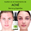 Solución Anti-acné DCI/Facial y corporal/Origen natural / 60 ml