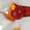 Axis Scientific Human Lumbar Herniating Disc Demonstration Anatomy Model for