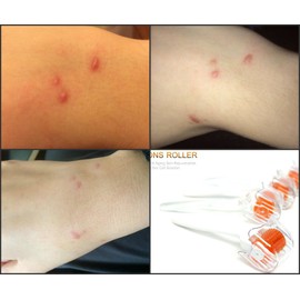 Dns Derma Skin Roller For Winkles & Scars (1.0mm)