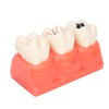 Tankredrug 4 Times Caries Evolution Model Detachable Teeth Disease Teach