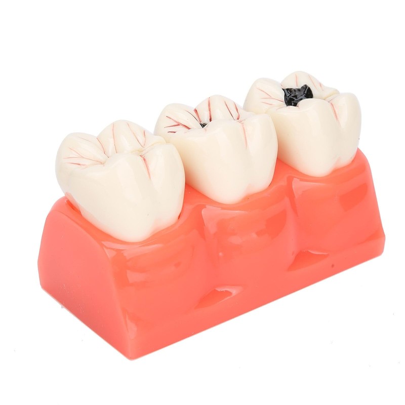 Tankredrug 4 Times Caries Evolution Model Detachable Teeth Disease Teach