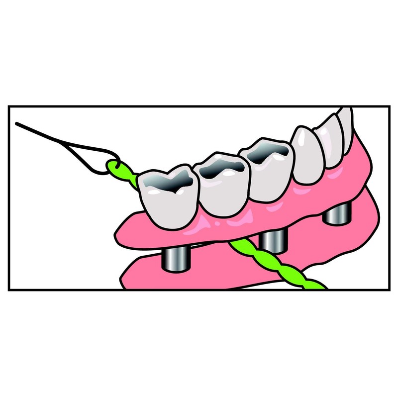IDontix Brace X-Floss, Green