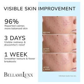 Tratamiento Bellamiluxx Para El Acné Quístico Facial: Crema