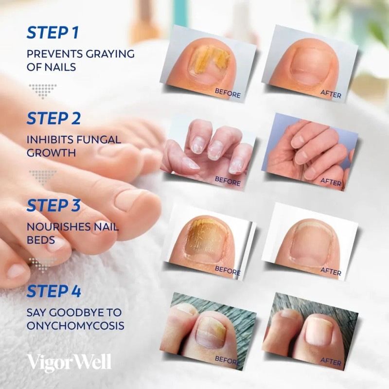 Tratamiento De Hongos En Las Uñas De Los Pies Vigorwell