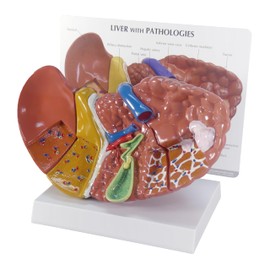 GPI Anatomicals - Liver Model with Common Pathologies, Replica for Human Anatomy and Physiology Education, Anatomy Model for Doctor's Offices and Classrooms, Medical Learning Resources