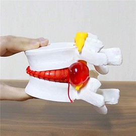 Global-Dental Anatomical Herniated Lumbar Vertebrae Disc Prolapse Model Human Anatomy Model White