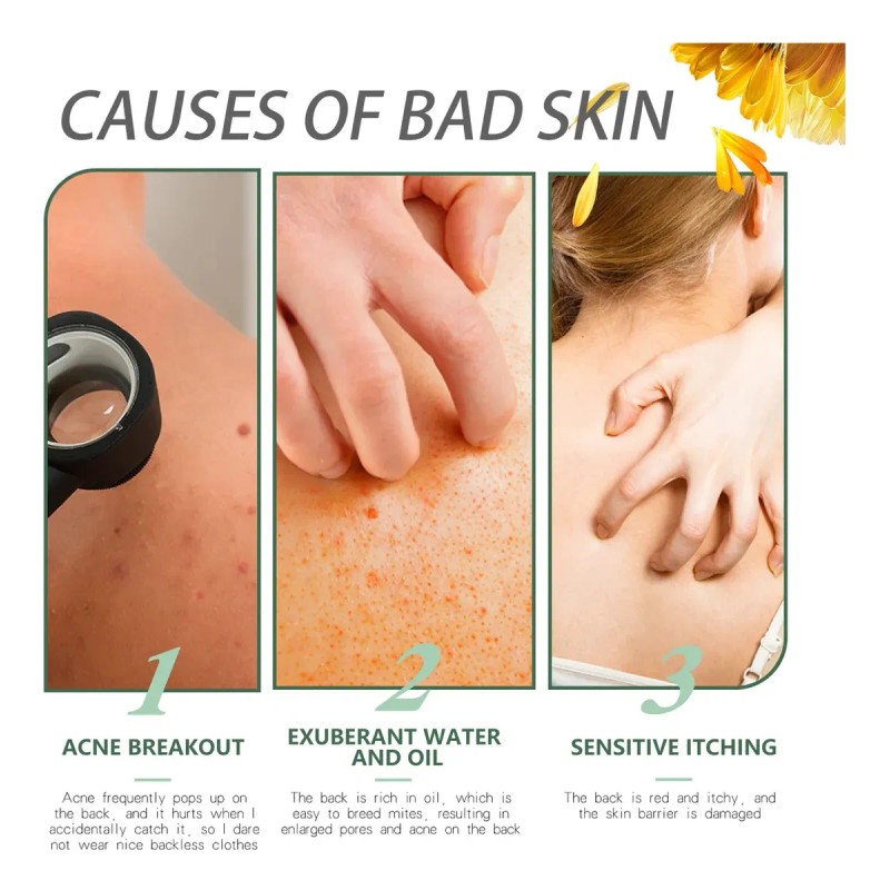 Crema Reparadora De Piel De Pollo Que Cura La Queratosis