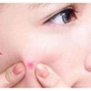 뾰루지짜기 등드름압출 초등학생코피지 볼블랙헤드 턱화이트헤드 Pimple Squeezing Back Acne Extraction