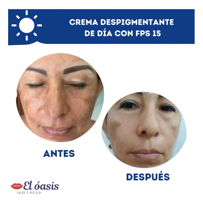 Kit Crema Día Despigmentante Piel Grasa +gel De Noche +jabón