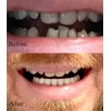 Instant Smile Professional Cosmetic Lower Teeth - New from Hand