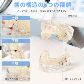 UKYCEORA Transparent Disease Teeth Model, Dental Implant Bridge Dental Teaching Crown Bridge Removable Model Teeth for Patient and Dental Student Education Transparent Blue