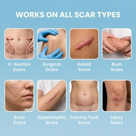 Medical Grade Silicone Scar Tape 1.6" x 120" – Reusable Sheets Roll for C Section, Keloid, Tummy Tuck & Surgical Scar Removal – Burn Scar Treatment Strips