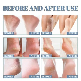 Intense Foot Repair Cream,Cracked Heel Repair Cream,Foot Cream for Cracked Heels and Dry Skin,Feet Cream Stick for Severe Dryness,Athletes Foot Cream,Softens Foot Moisturiser for Very Dry Feet