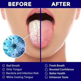 Rascador de lengua de acero inoxidable, paquete de dos unidades, limpiador de lengua, para un aliento fresco y una mejor salud bucal, raspadores de lengua de acero inoxidable, limpiador de lengua para niños y adultos ORAVIX