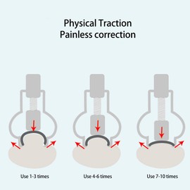 Ingrown Toenail Lifter Foot Care Tool Toenail Clamp Stainless Steel Ingrown Toenail Tools Stainless Steel Professional For Paronychia, Ingrown Toenail Clamp (Silver)