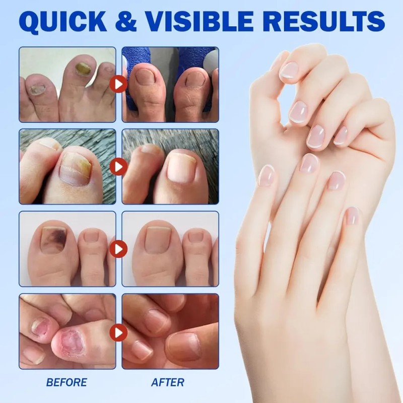 N8c| Parches For Uñas, 42 Unidades, Tratamiento For Uñas De