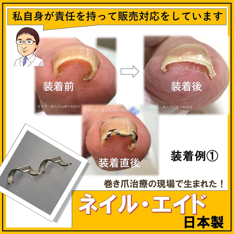 Nail Aid 0.6 inch (14 mm) Winding Nail Correction Self-Winding