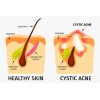 SUPPLEMENTS4ME ACNE QUISTICO SOLUCION HOMBRES Y MUJERES - Made in